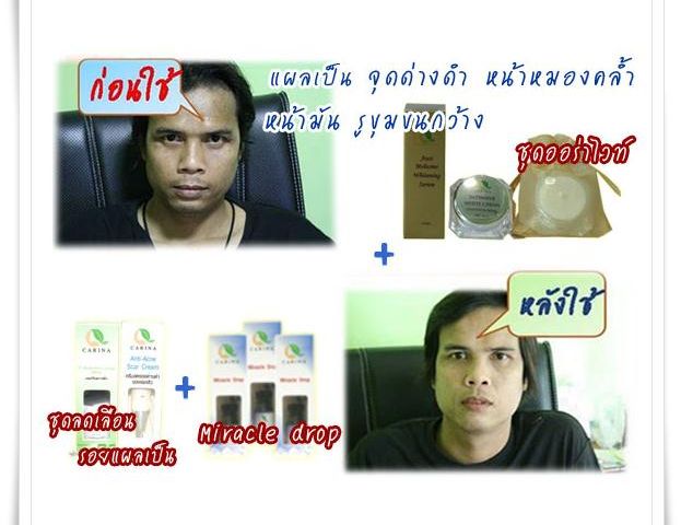 เซตลดรอยแผลเป็นจากสิว